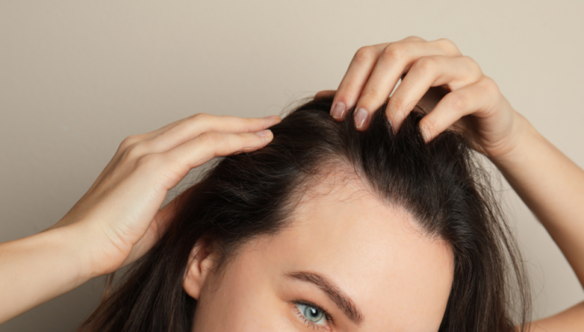 Women experience thinning hair.